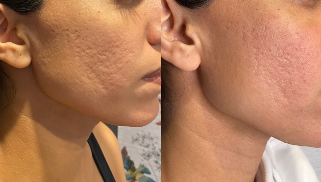 acne-scars-b&a