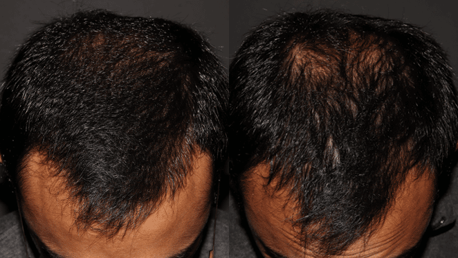 Hair Related Concerns B&A | Vancouver & Surrey BC