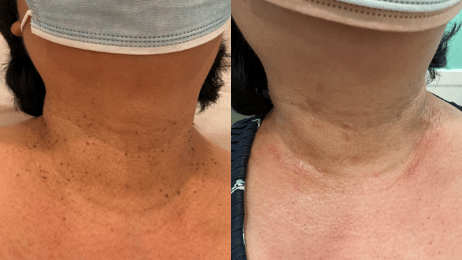 Skin Lesion Removal B&A | Vancouver & Surrey BC