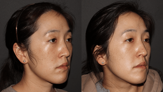 Acne Clinic B&A | Vancouver & Surrey BC