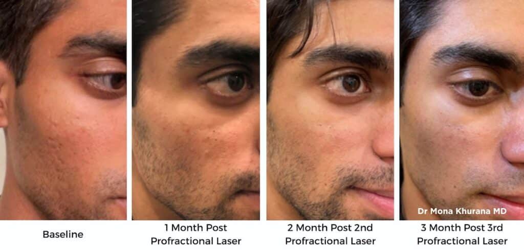 Acne Scarring Vancouver