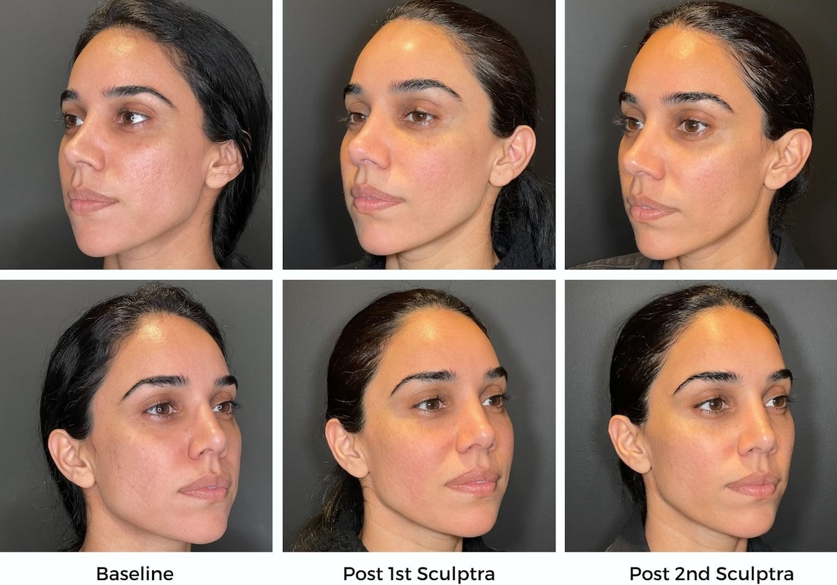 acne-scarring-vancouver-treatment-solutions-lasers