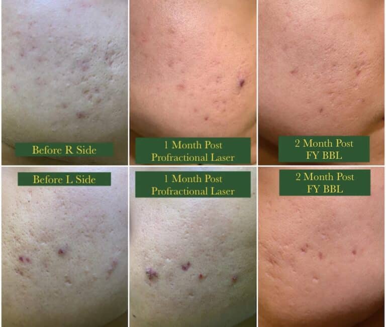 Acne Scarring Vancouver Treatment Solutions Lasers