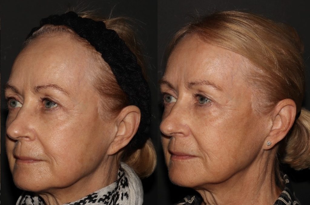 sculptra vancouver