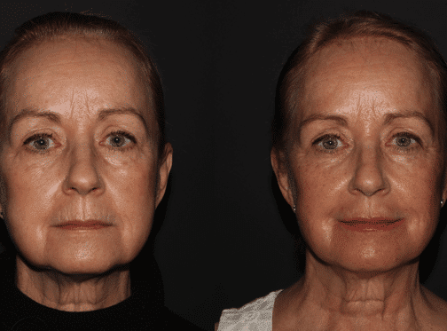Facial rejuvenation Vancouver