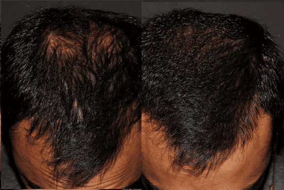 Hair Loss PRP Vancouver