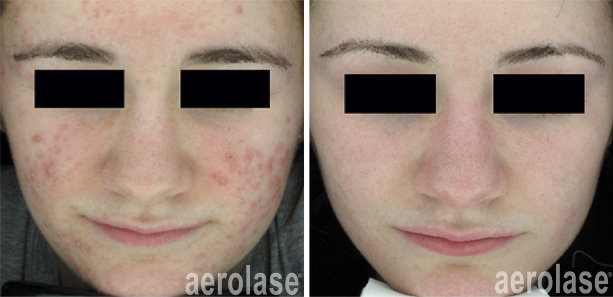NeoClear Acne Laser Treatments / Vancouver @ Shine MD