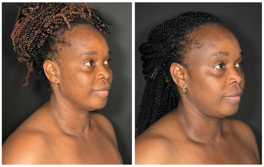 SKIN OF COLOR TREATMENT IN VANCOUVER - DPN REMOVAL