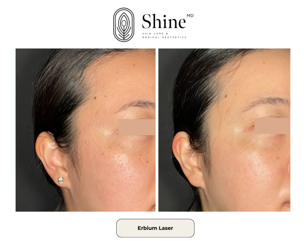 Logo for Shine MD with two before/after side-by-side close-ups of the temple/cheek showing improved skin after Erbium laser treatment; left shows more texture and redness, right smoother skin.