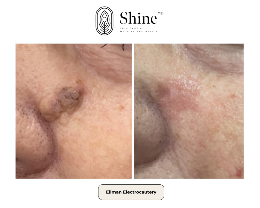 Side-by-side close-up of facial skin: left shows rough texture and pigmentation; right shows smoother, improved skin after treatment.