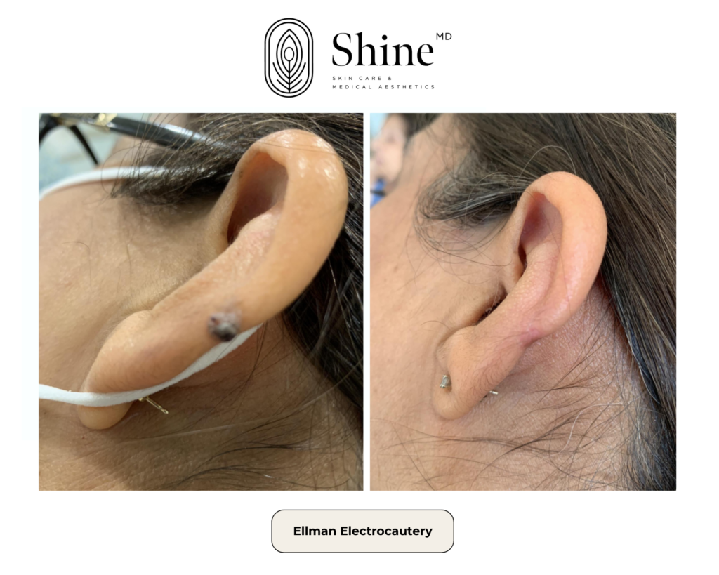 Before-and-after close-ups of a ear lobes (left and right) from an Ellman electrocoagulation treatment, shown on Shine MD site