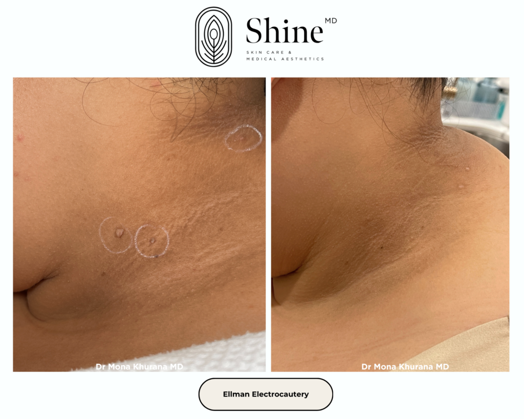 Side-by-side before-and-after photos of neck skin showing improvement after Ellman Electrocur... treatment; circles and scars visible on the left, clearer skin on the right, Shine MD branding.