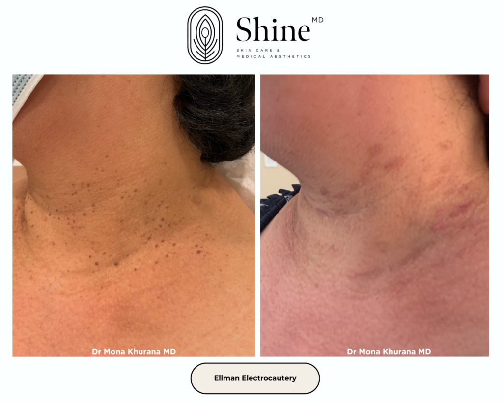 Two side-by-side close-up neck photos showing skin texture: left with numerous small dark spots, right with redness and acne marks/bumps.