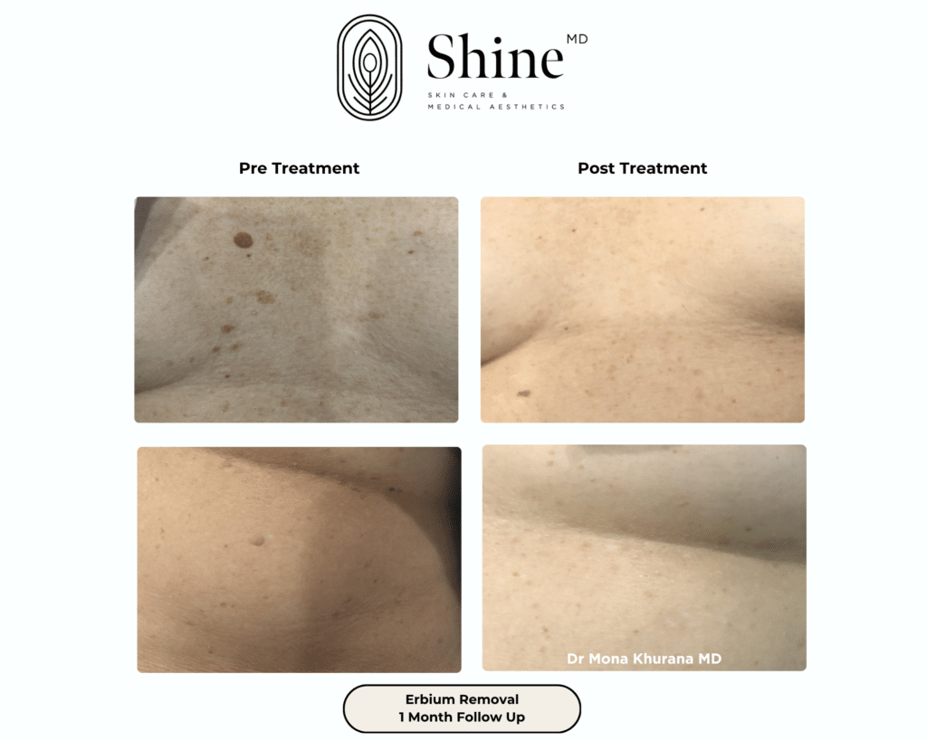 Erbium removal