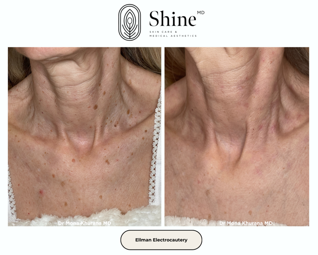 Lesion Removal Website Page