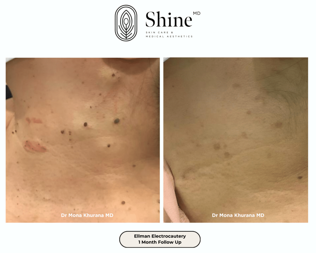Side-by-side close-up photos of the neck showing pigmented spots and minor scars (before) versus smoother, reduced marks (after) following Ellman electrocautery treatment.