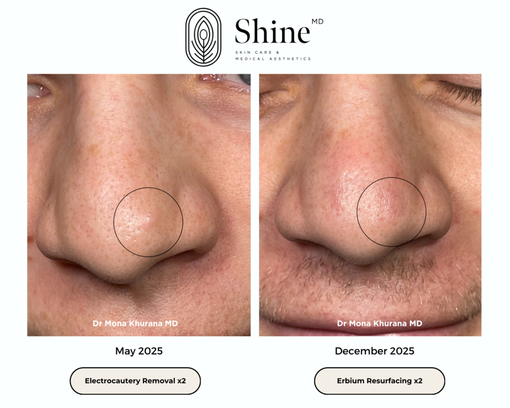 mole removal