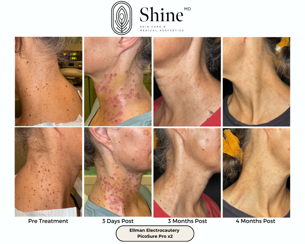 Progress photo grid of neck skin before and after laser treatment, showing reduced spots and redness across timepoints: Pre Treatment, 3 Days Post, 3 Months Post, 4 Months Post.