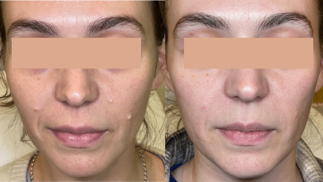 Left and right side-by-side photos of a woman’s face showing before (left) and after (right) a skin treatment; the left image shows acne and blemishes, while the right image shows clearer, smoother skin with reduced redness.