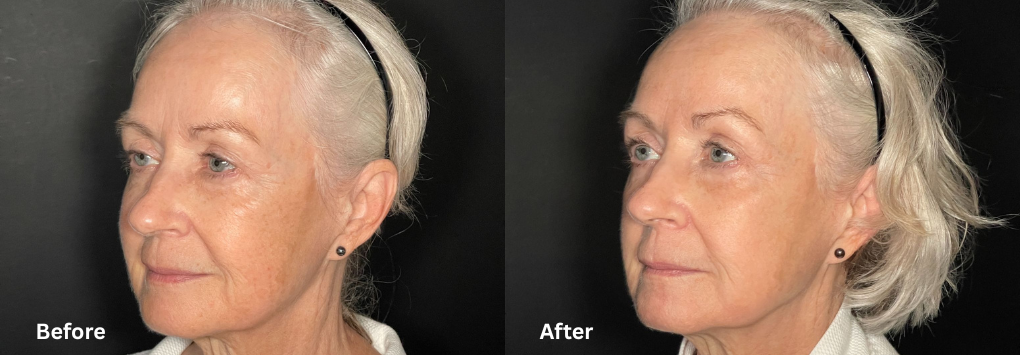 Co2 laser before and after at shine md