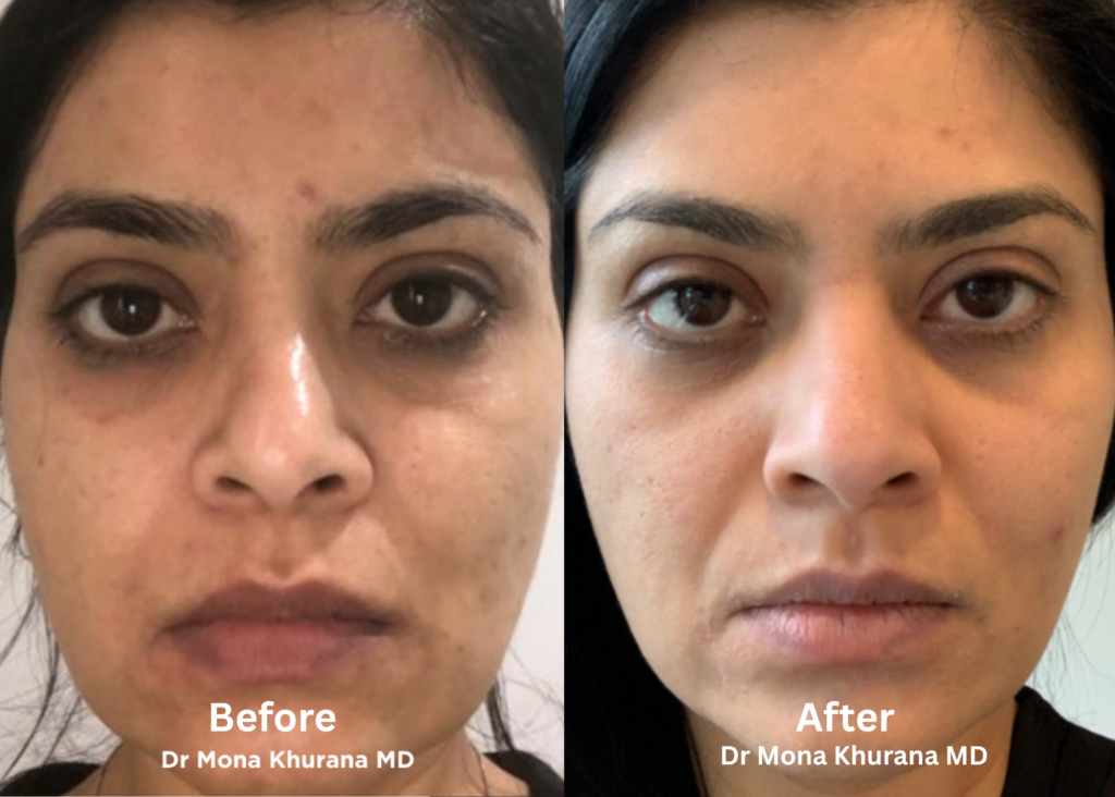 Pigmentation Vancouver